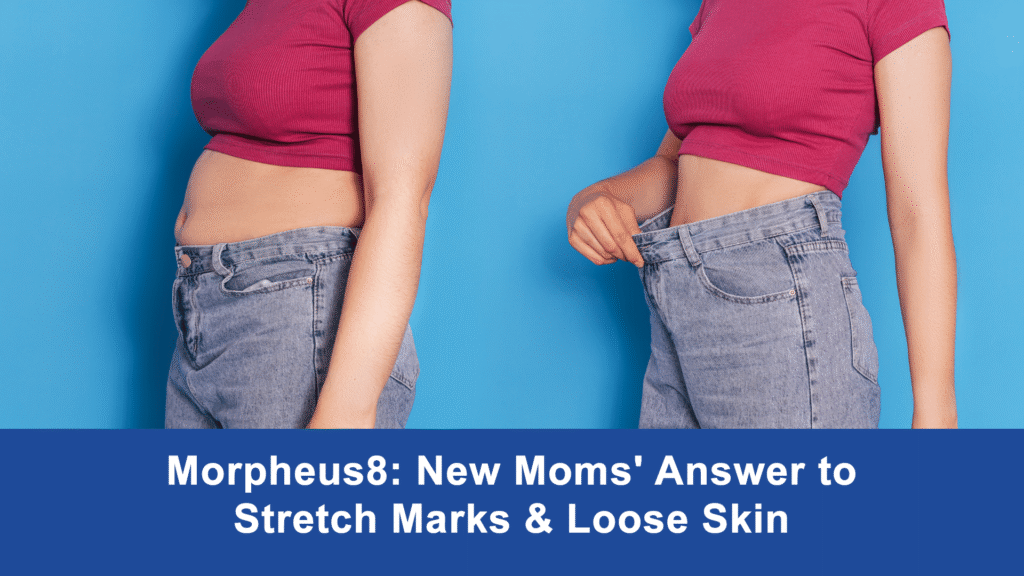 Morpheus8: New Moms' Answer to Stretch Marks & Loose Skin