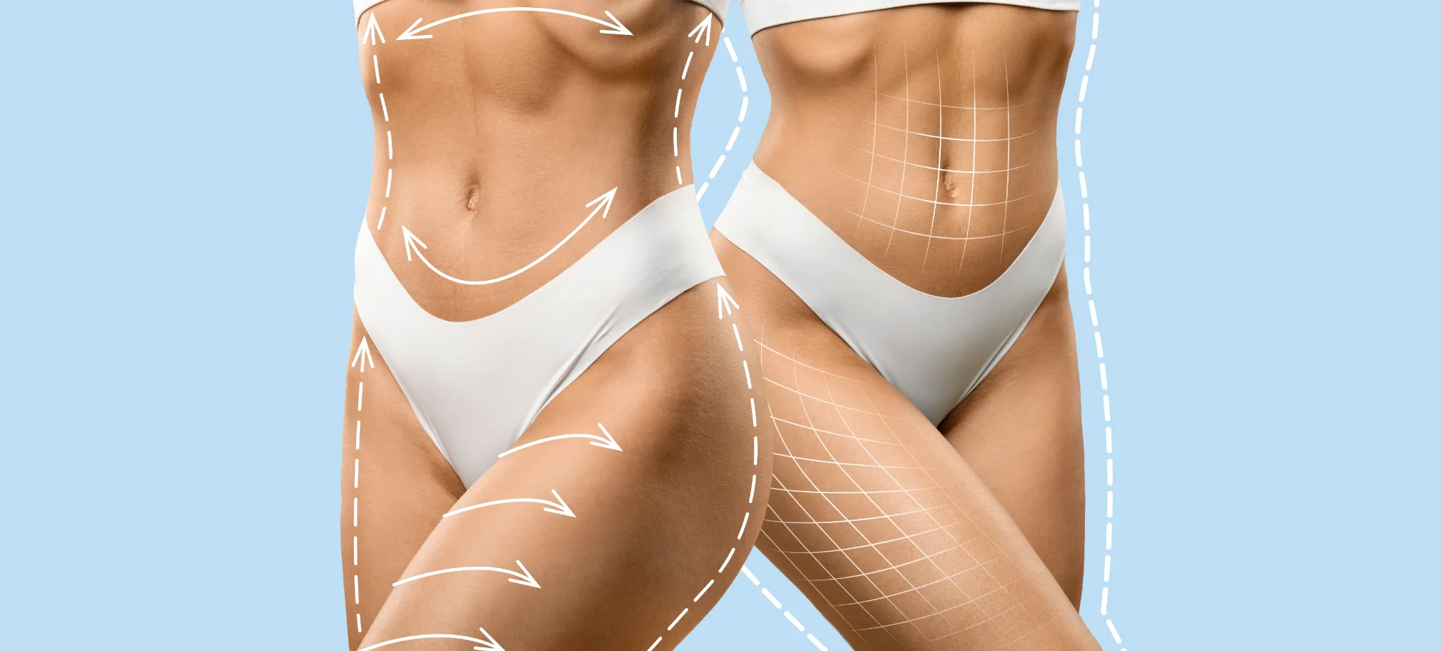 Ems body sculpting lines shown on model