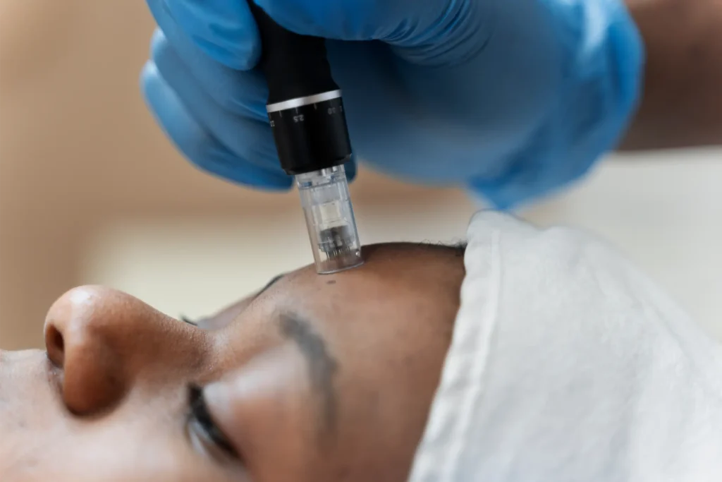 Microneedling machine lightly pressing against woman's forehead