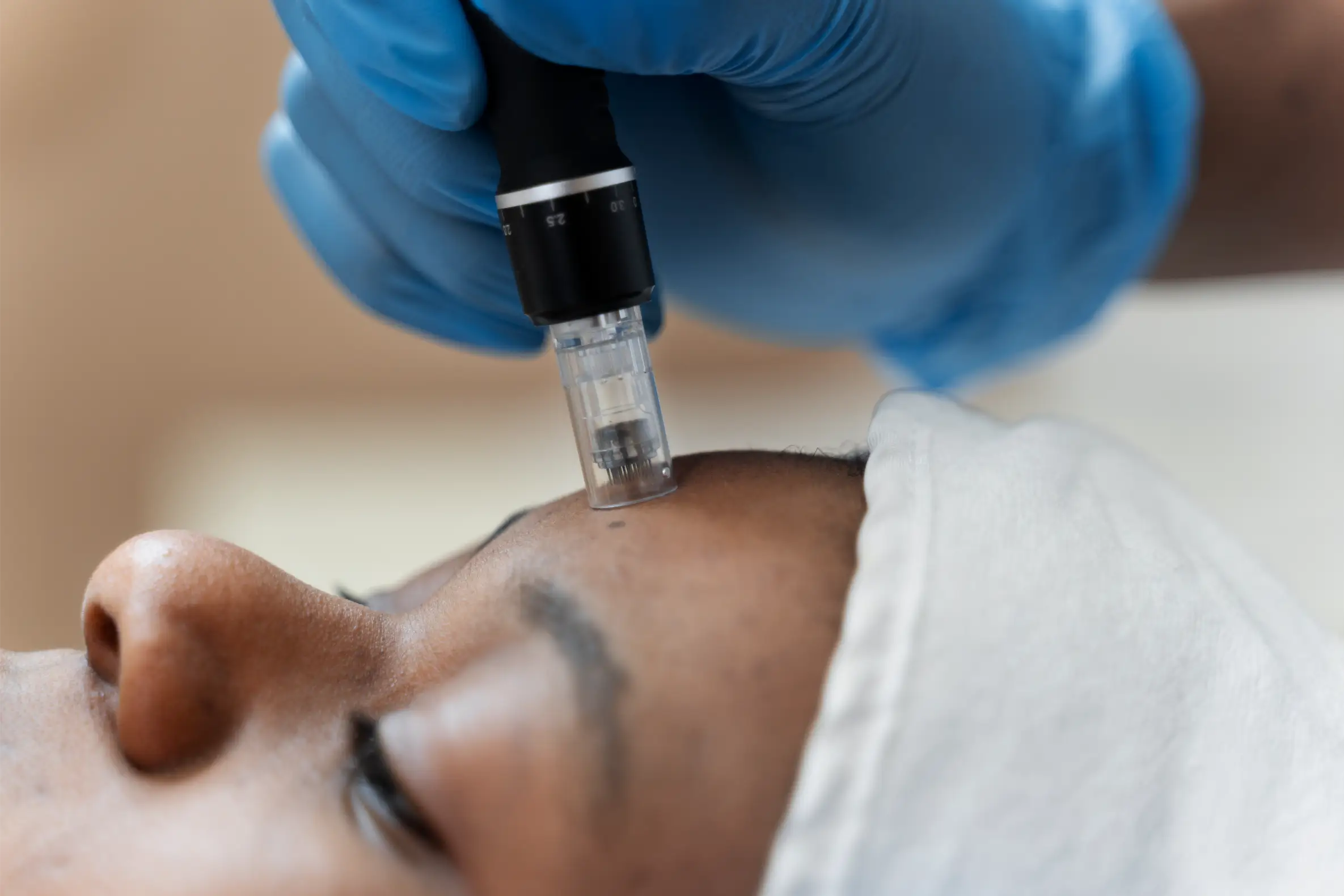 Microneedling machine lightly pressing against woman's forehead