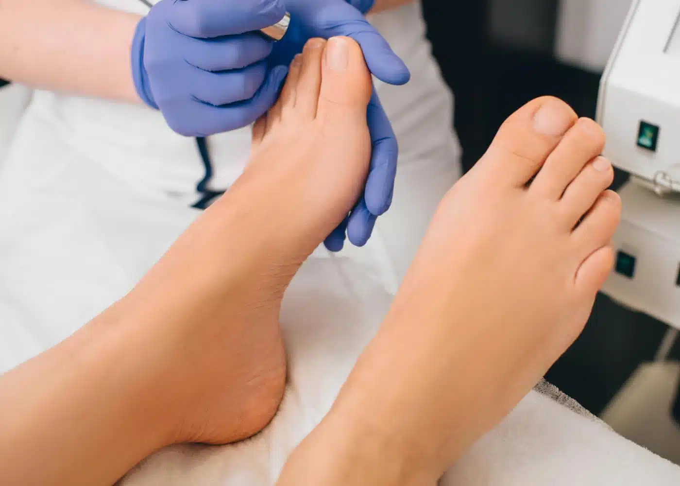 Person getting nail fungus removal treeatment