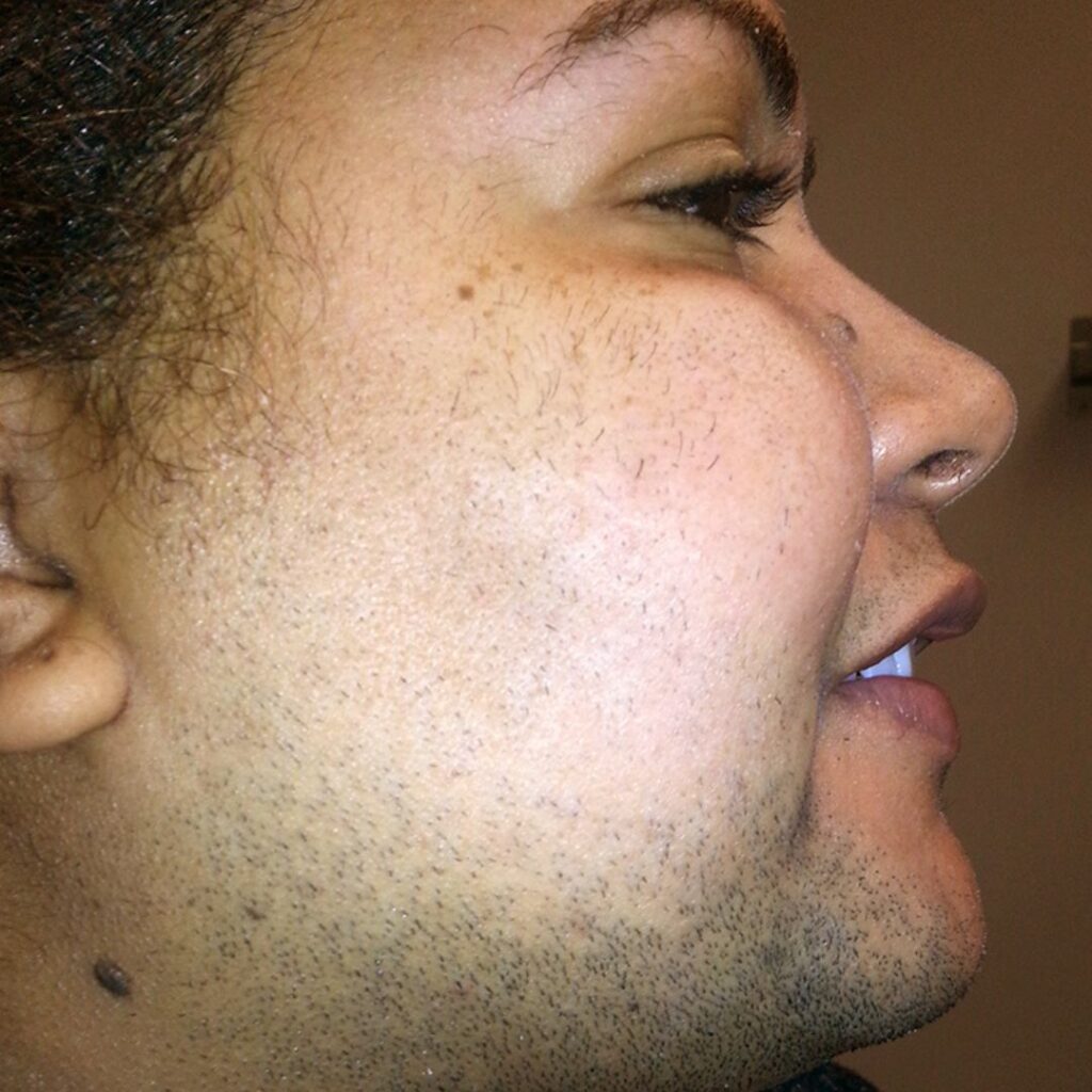 client with hair on face before picture