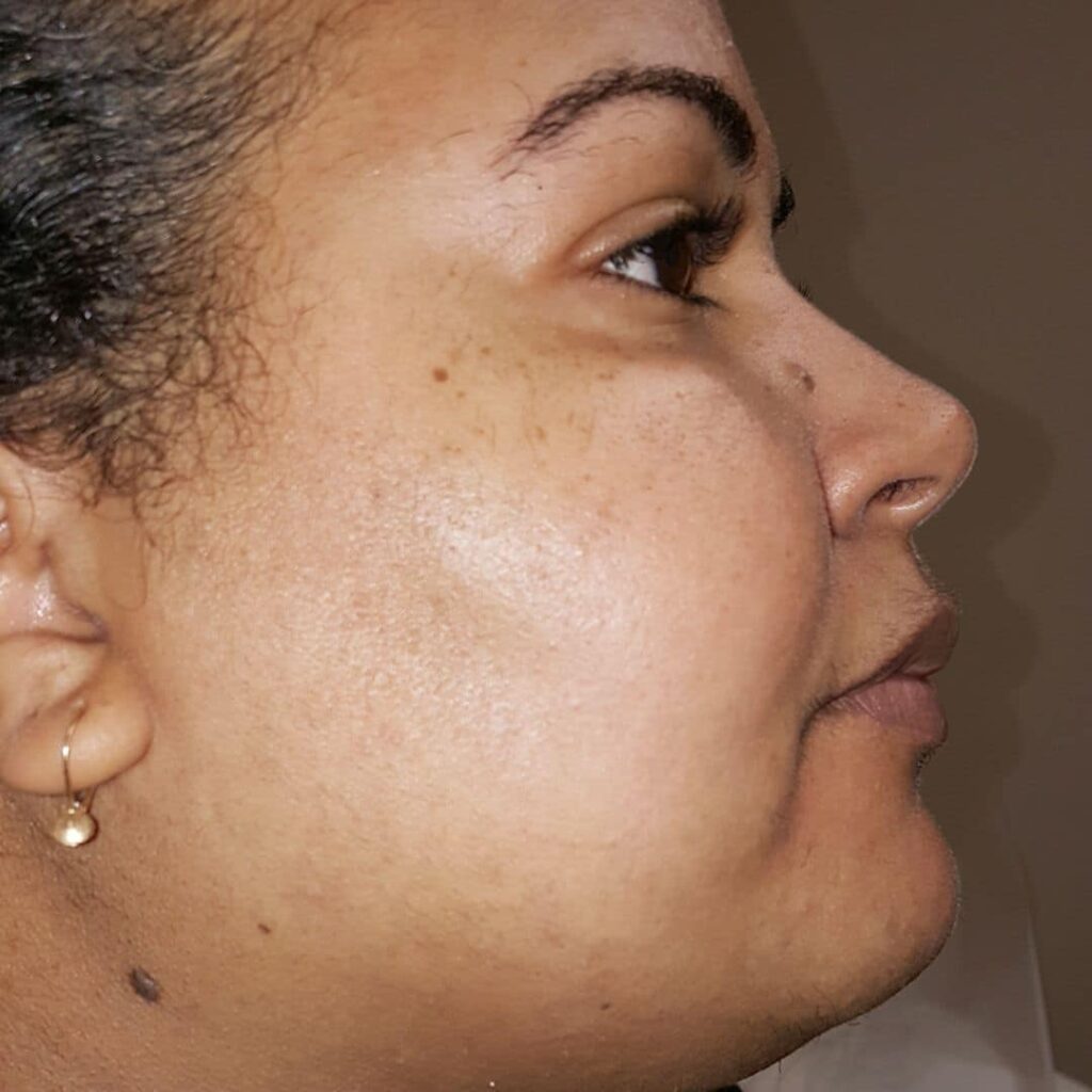 Client face without hair after picture