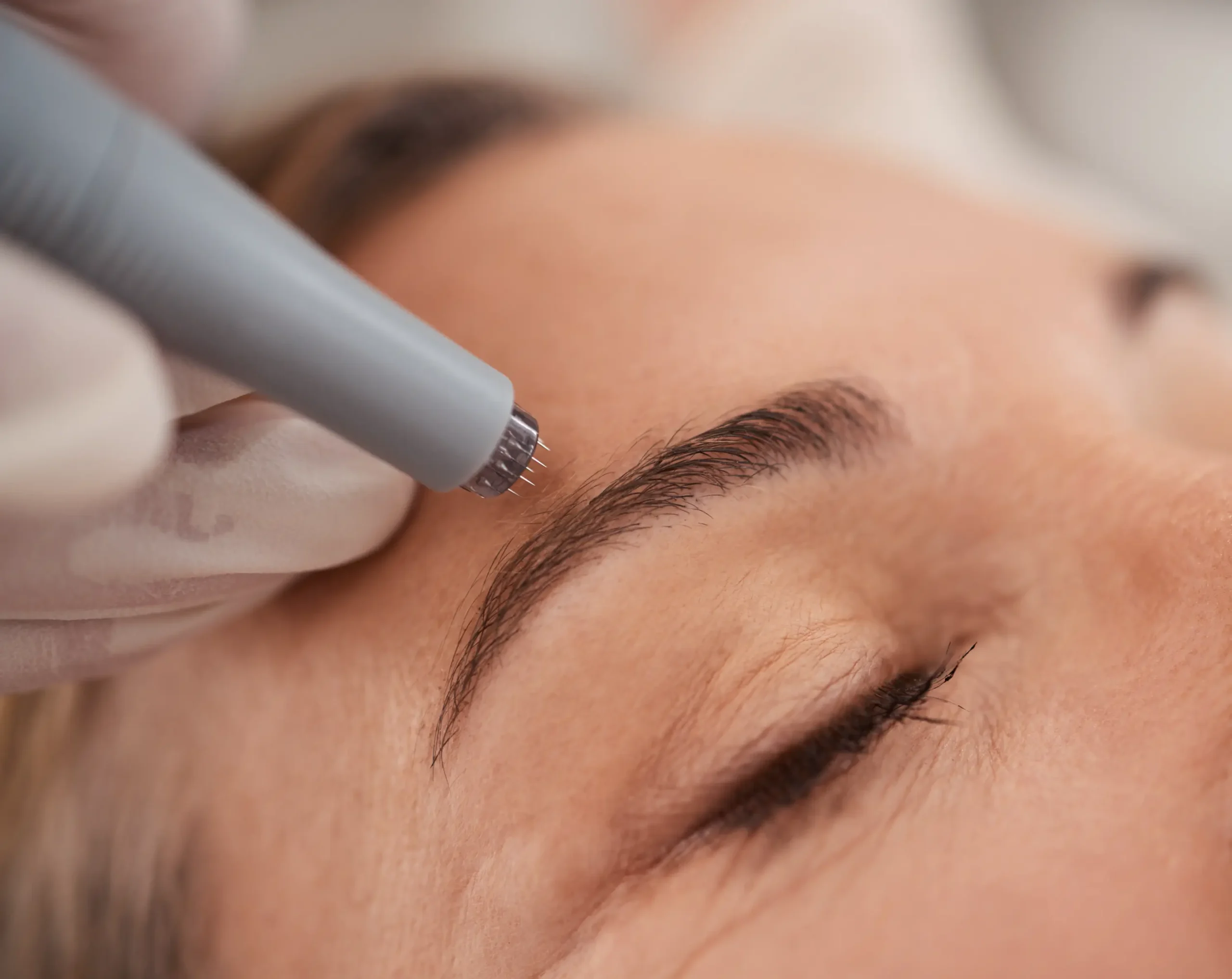 Close up of microneedling needles near forehead