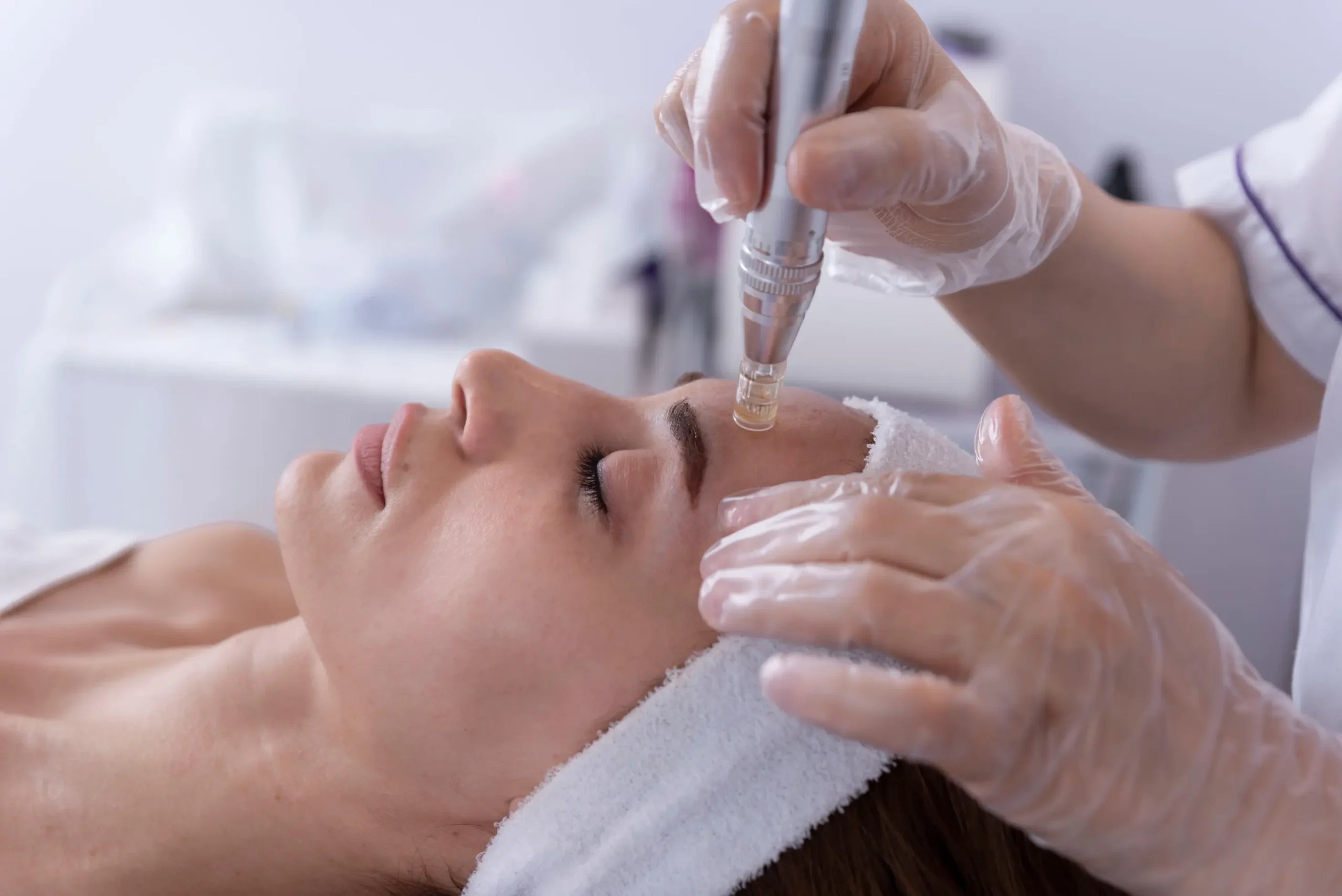 Microneedling tool used on woman's forehead