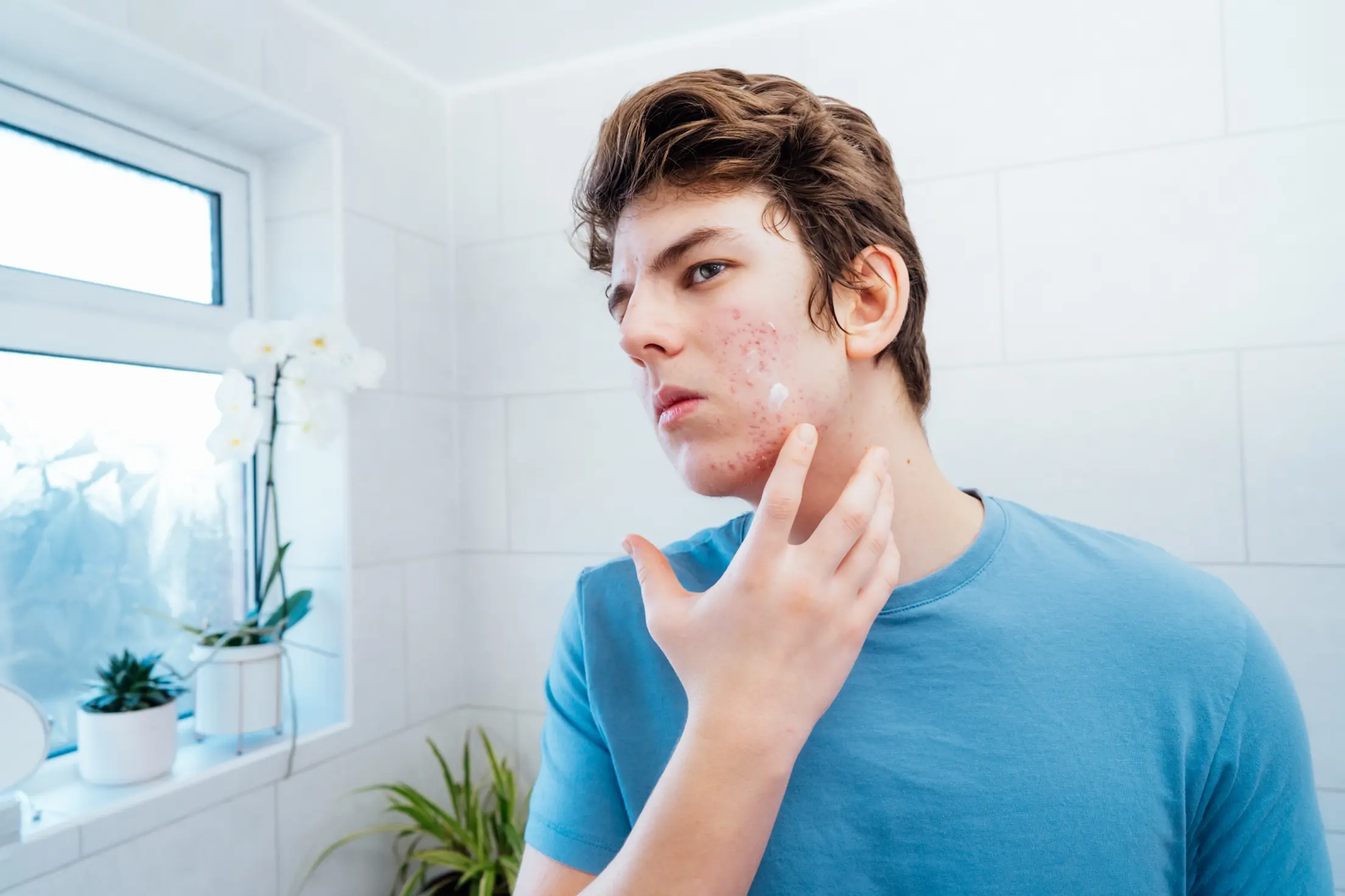 Acne and Scar Treatment for Men