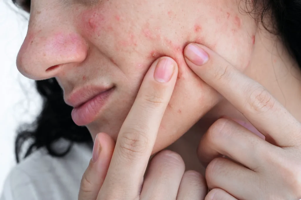 person touching acne scars