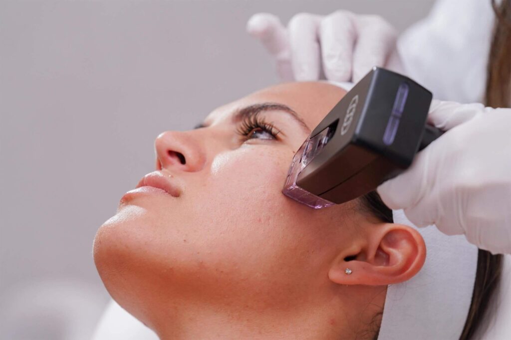 Woman getting morpheus8 on face