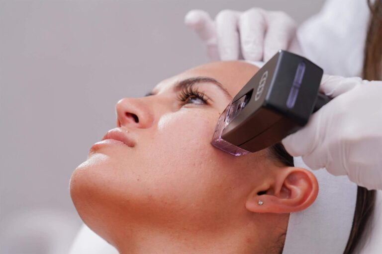 Woman getting morpheus8 on face