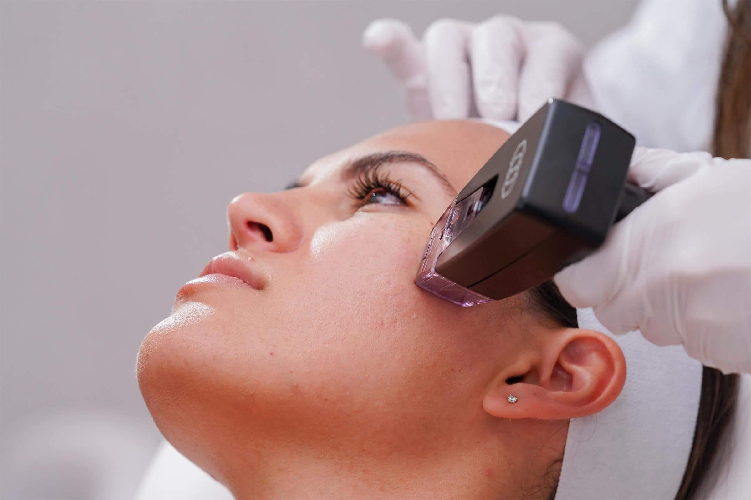 Woman getting morpheus8 on face