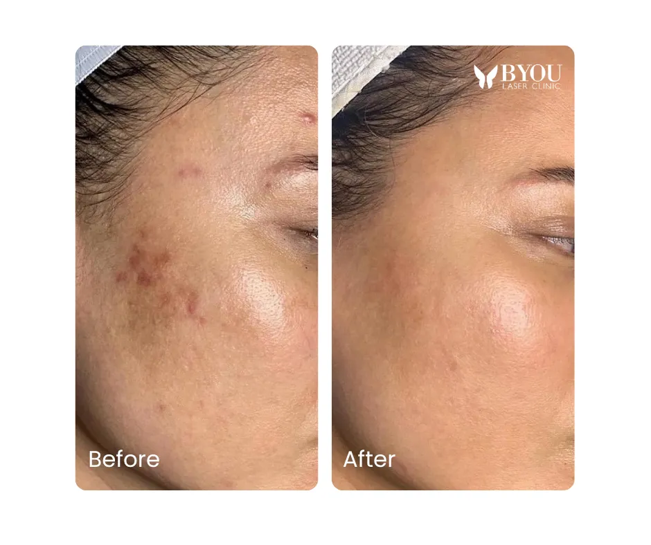 laser spot removal before & after