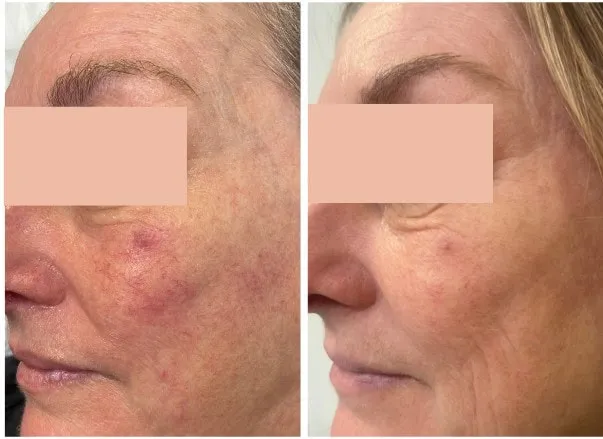 Before and After photo of client doing Rosacea laser treatment