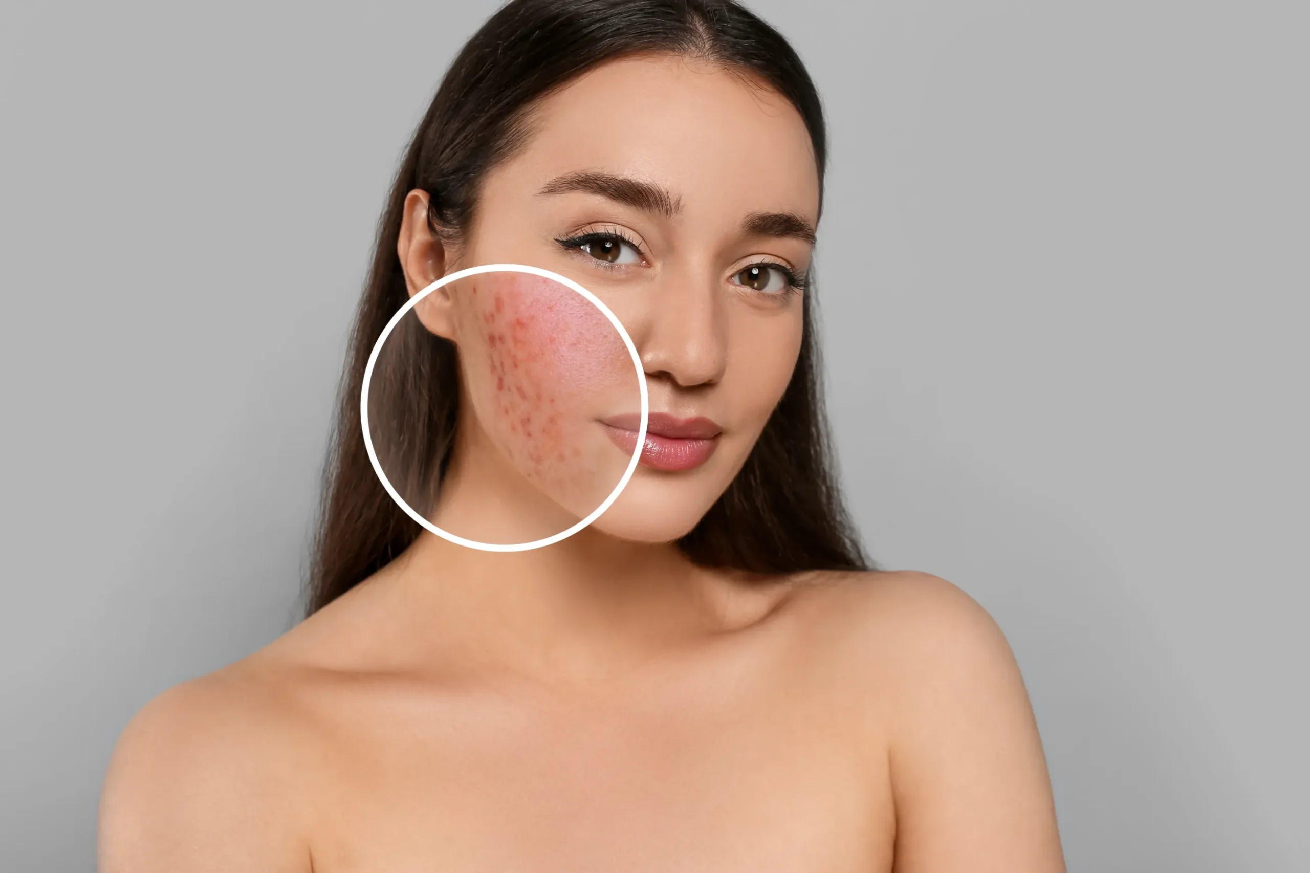 Woman with magnifying glass showing her rosacea