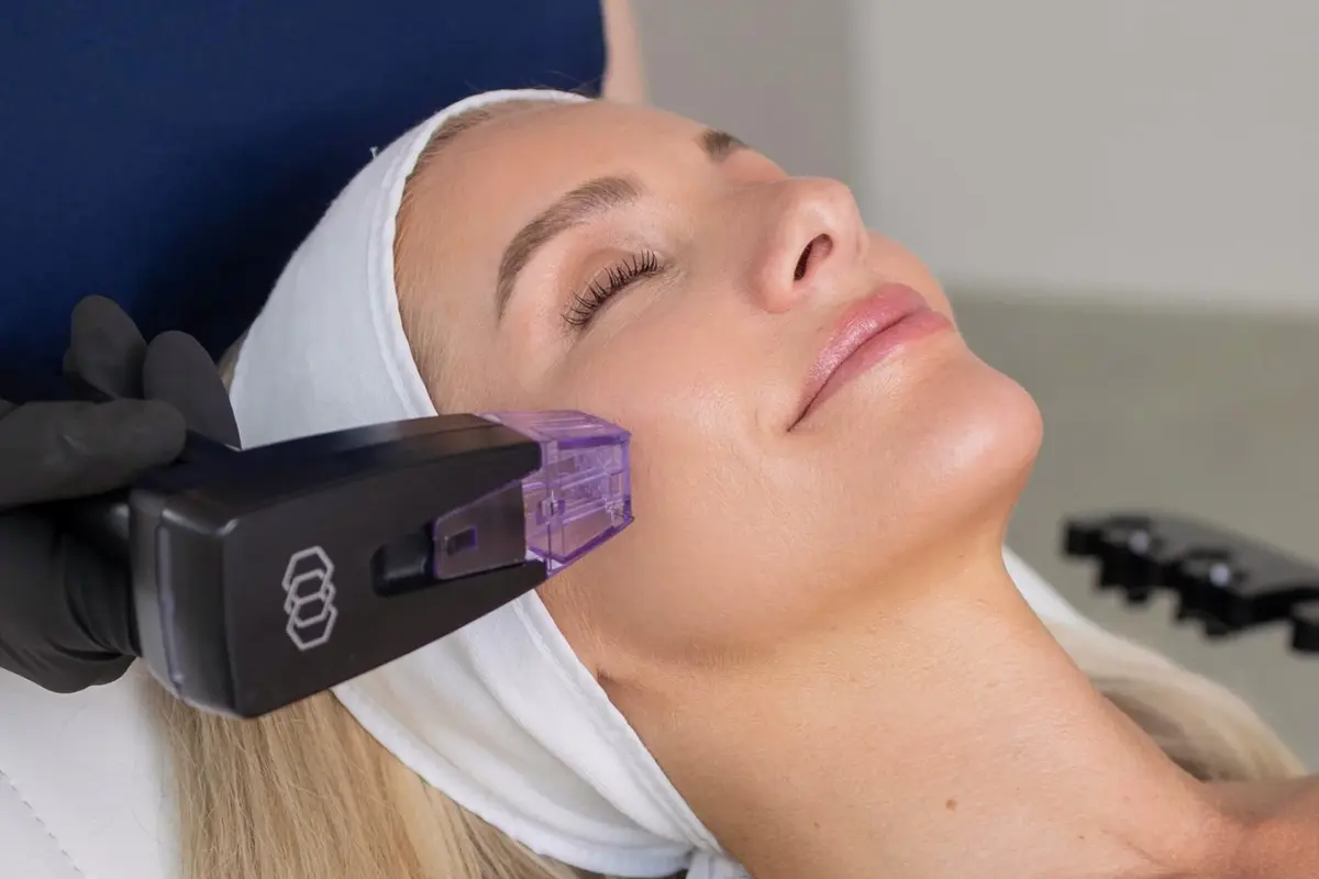 Morpheus8 skin treatment at BYou Laser Clinic